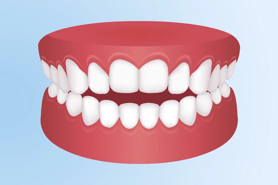 Maloclusión dental mordida abierta tratamiento ortodoncia
