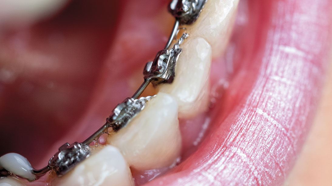 Ortodoncia lingual brackets invisibles cara interna dientes