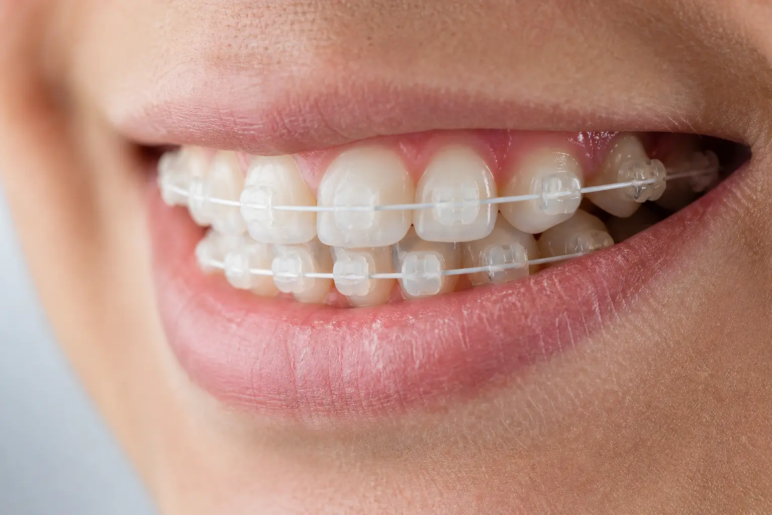 Sonrisa con brackets cerámicos translúcidos en adolescente, ortodoncia estética en Bormujos Sevilla