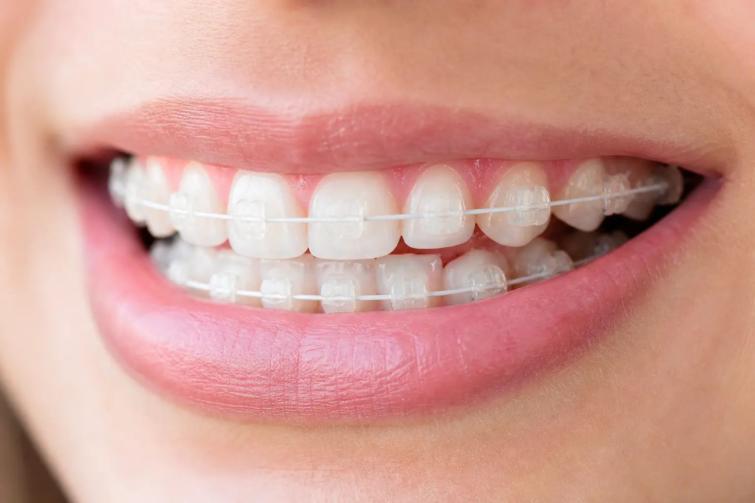 Mujer adulta con caja de Invisalign, tiempo de tratamiento ortodoncia invisible Sevilla