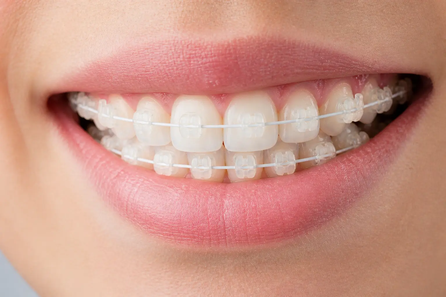 Comparativa Invisalign vs Spark Aligners en Sevilla, alineadores transparentes