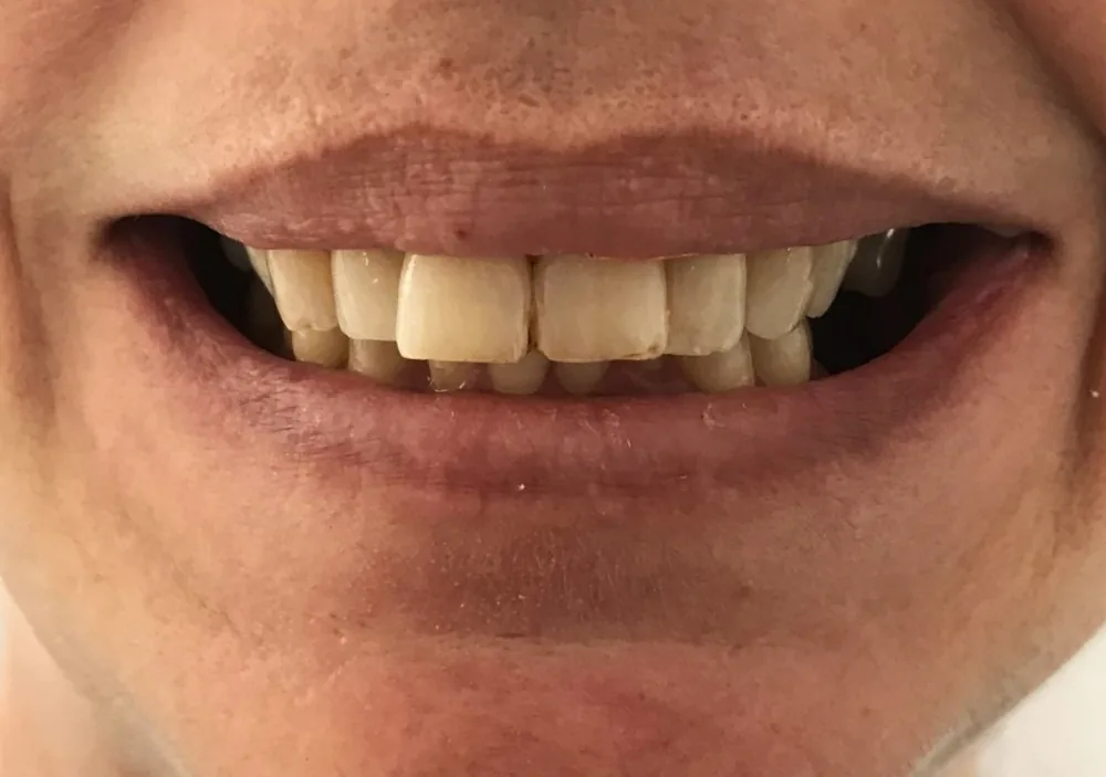 Antes — Sonrisa renovada, ortodoncia Dra. Amalfi Mármol